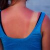 cómo sufre nuestra piel con el sol