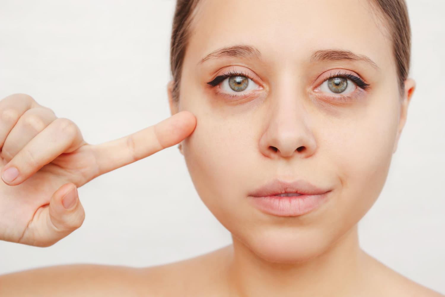 cómo hay que tratar las ojeras